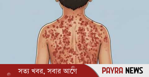 হামের লক্ষণ ও প্রতিকার, যা জানা জরুরি