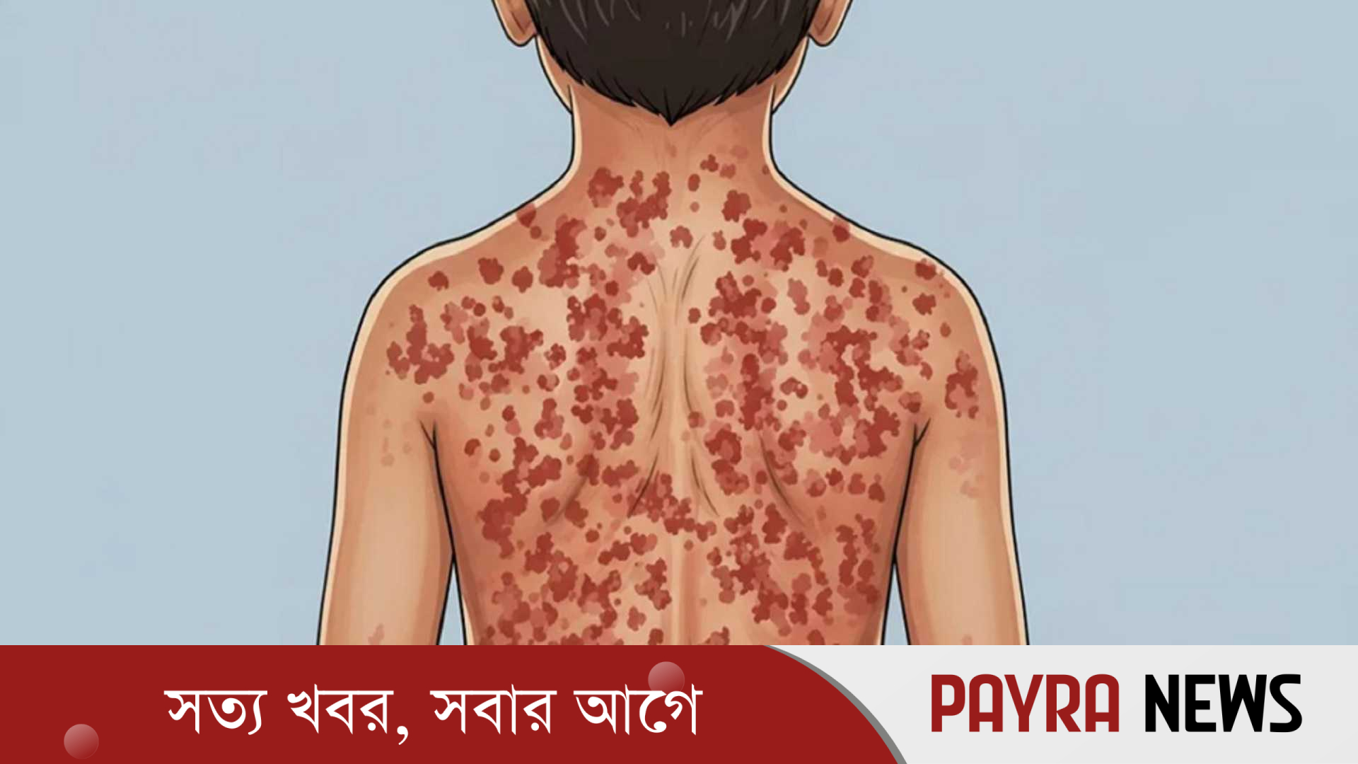 হামের লক্ষণ ও প্রতিকার, যা জানা জরুরি