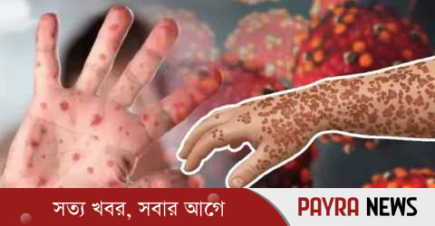 হাম ও উপসর্গে আরও ৭ শিশুর মৃত্যু