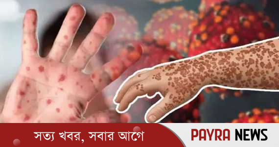 ২৪ ঘণ্টায় হাম ও হামের উপসর্গ নিয়ে ৯ শিশুর মৃত্যু