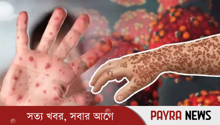 ২৪ ঘণ্টায় হাম ও হামের উপসর্গ নিয়ে ৯ শিশুর মৃত্যু